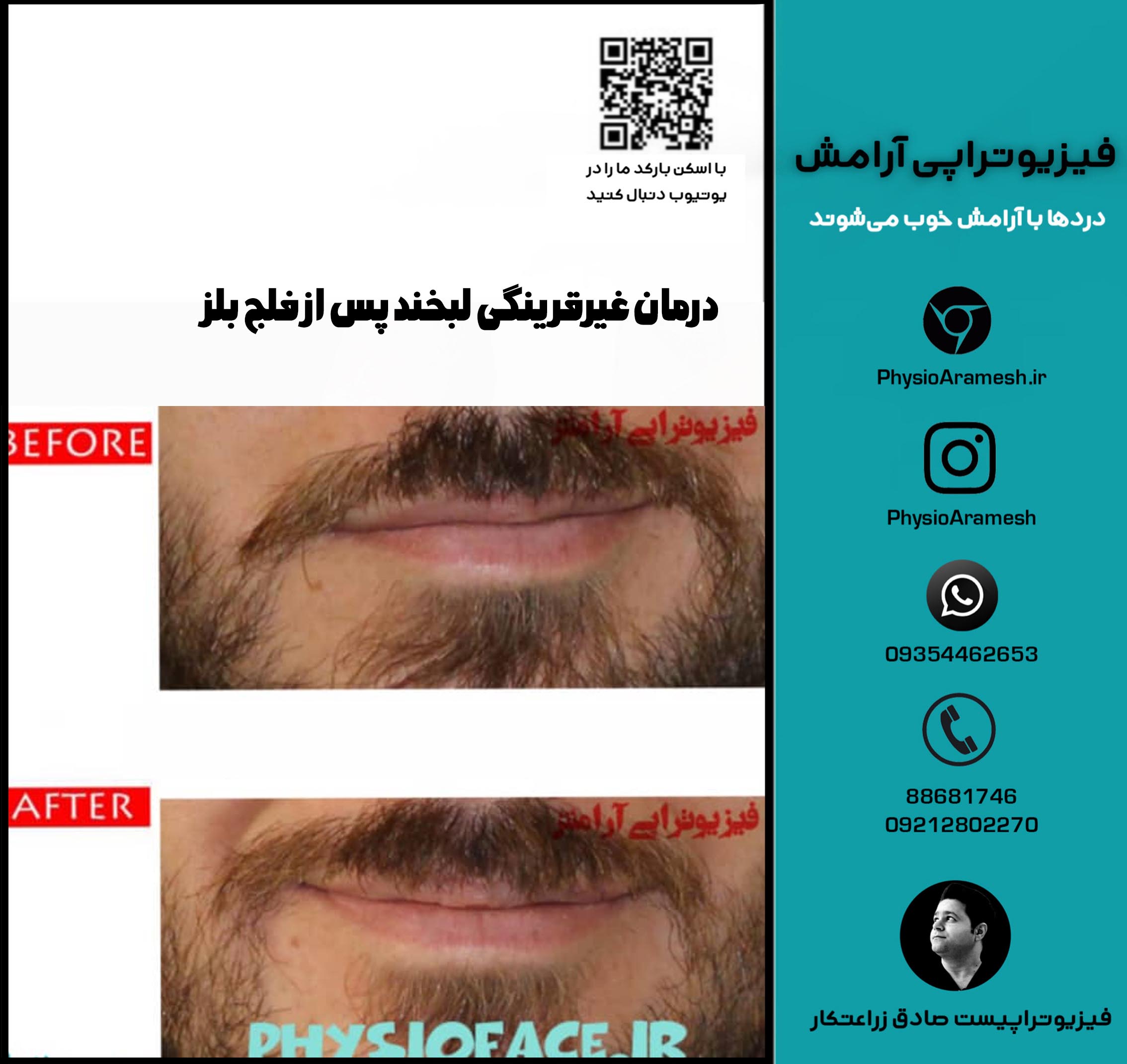 درمان غیرقرینگی لبخند پس از فلج بلز